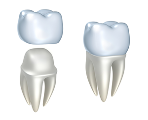 Dental Crowns - Dentist Vidalia, LA | S. Lee Falkenheiner